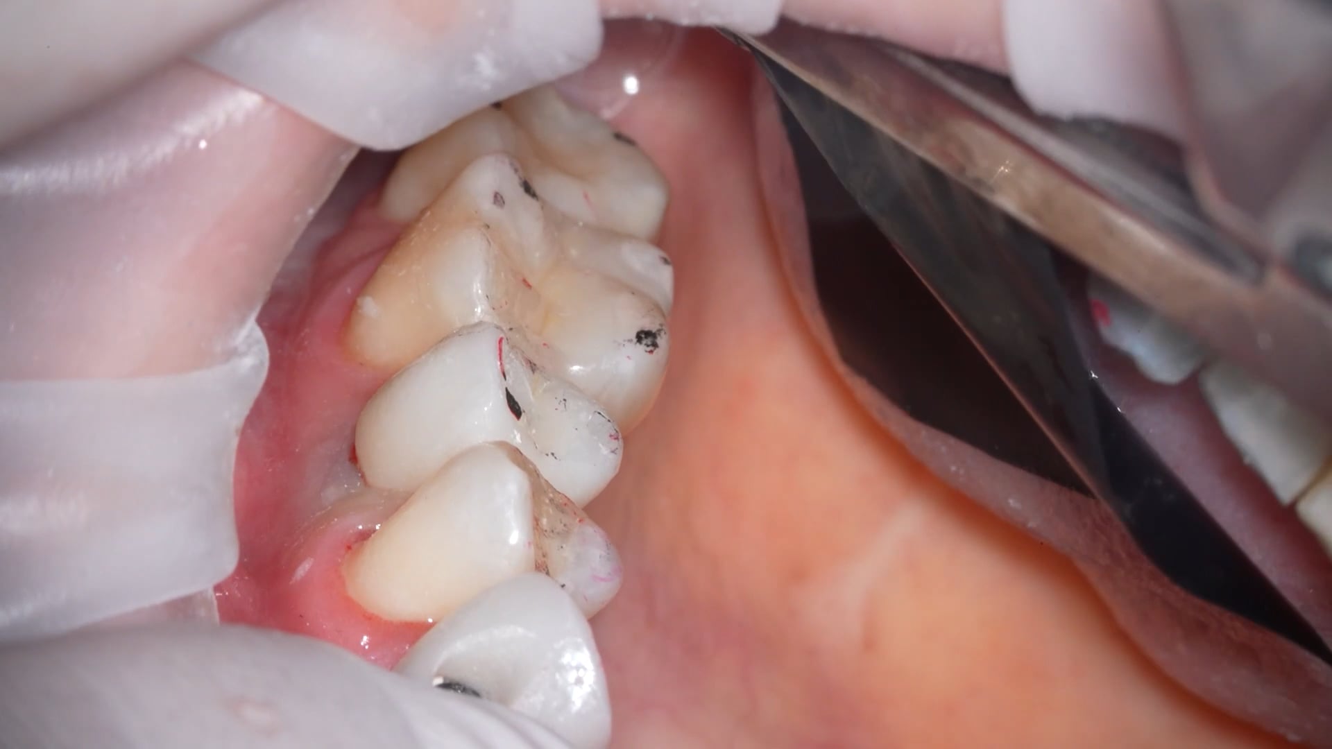 【GPB_direct-bonding_lup_050】研磨、咬合調整