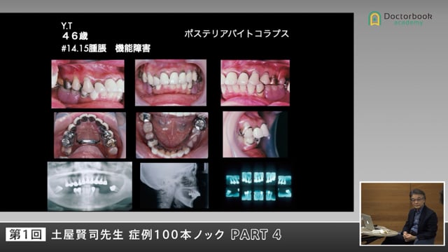 全顎補綴25年経過症例に学ぶ―噛めない患者をどう再建するか #4