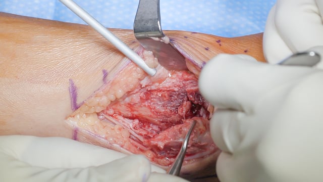 Operative Repair of Supination Adduction Ankle Fracture