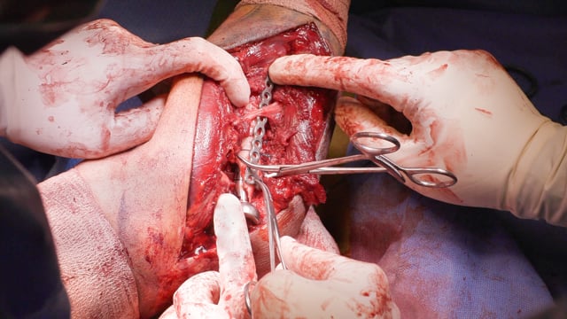 Complex Terrible Triad with a Concomitant Radial Shaft Fracture