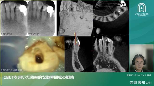 CBCTを用いた効率的な髄室開拡の戦略