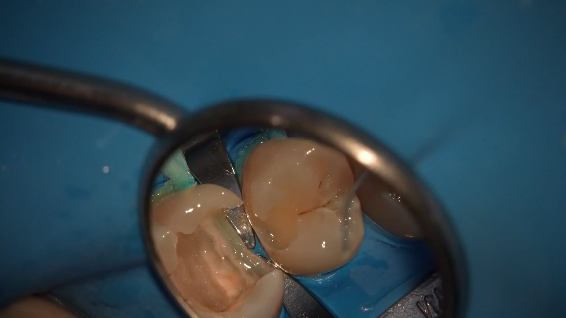 【GPB_direct-bonding_lup_040】充填