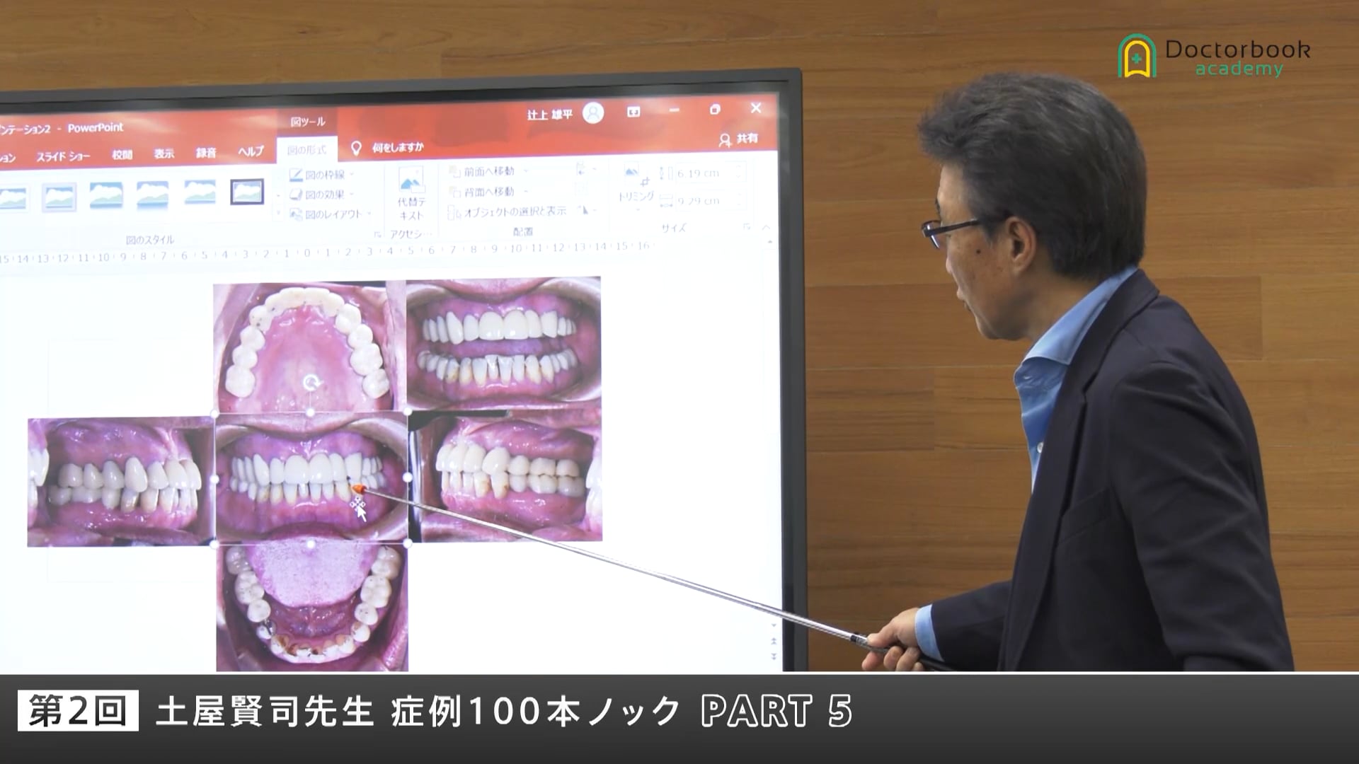 上顎犬歯欠損症例から考える―アンテリアガイドと補綴設計の考え方 #5