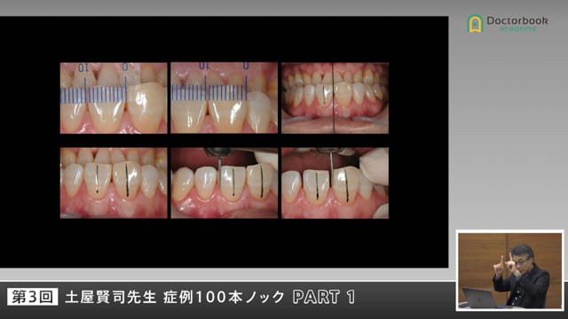 歯周治療と矯正治療を重ねてつくる理想的アーチ #1