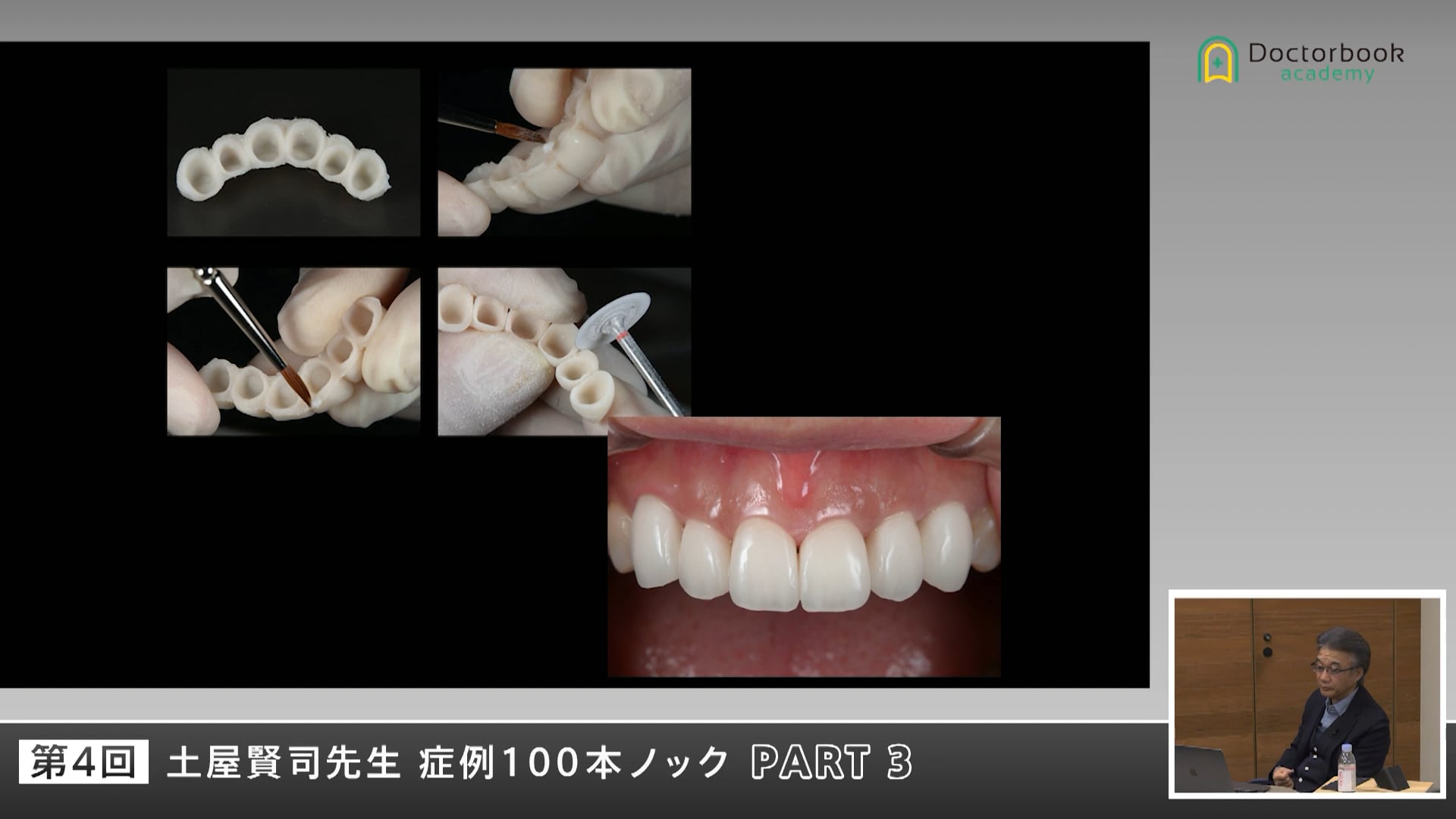 歯の位置づけから考える補綴と矯正のバランス #3