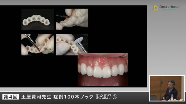 歯の位置づけから考える補綴と矯正のバランス #3