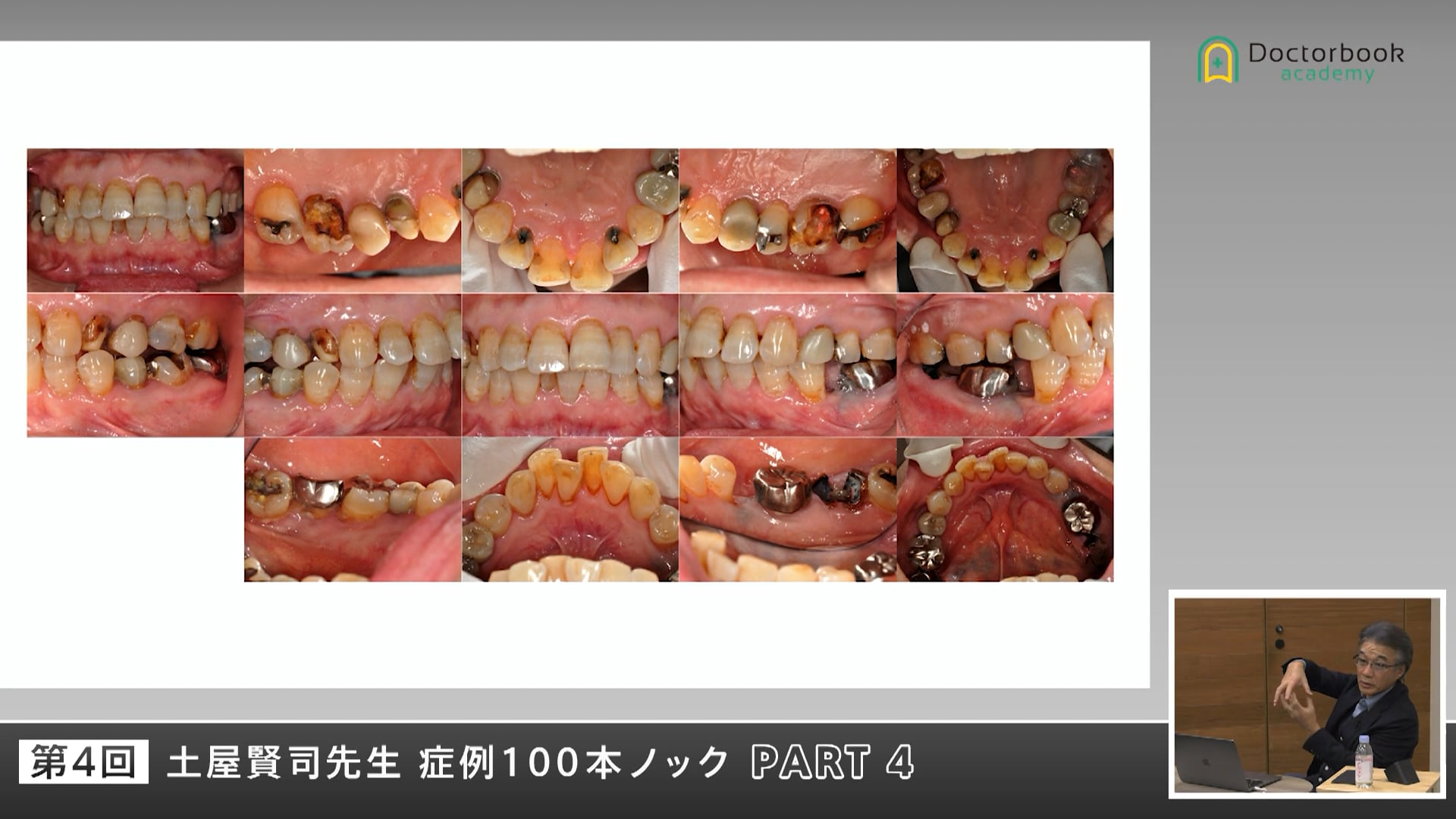 破折や脱離を繰り返す補綴症例を診断から見直す #4
