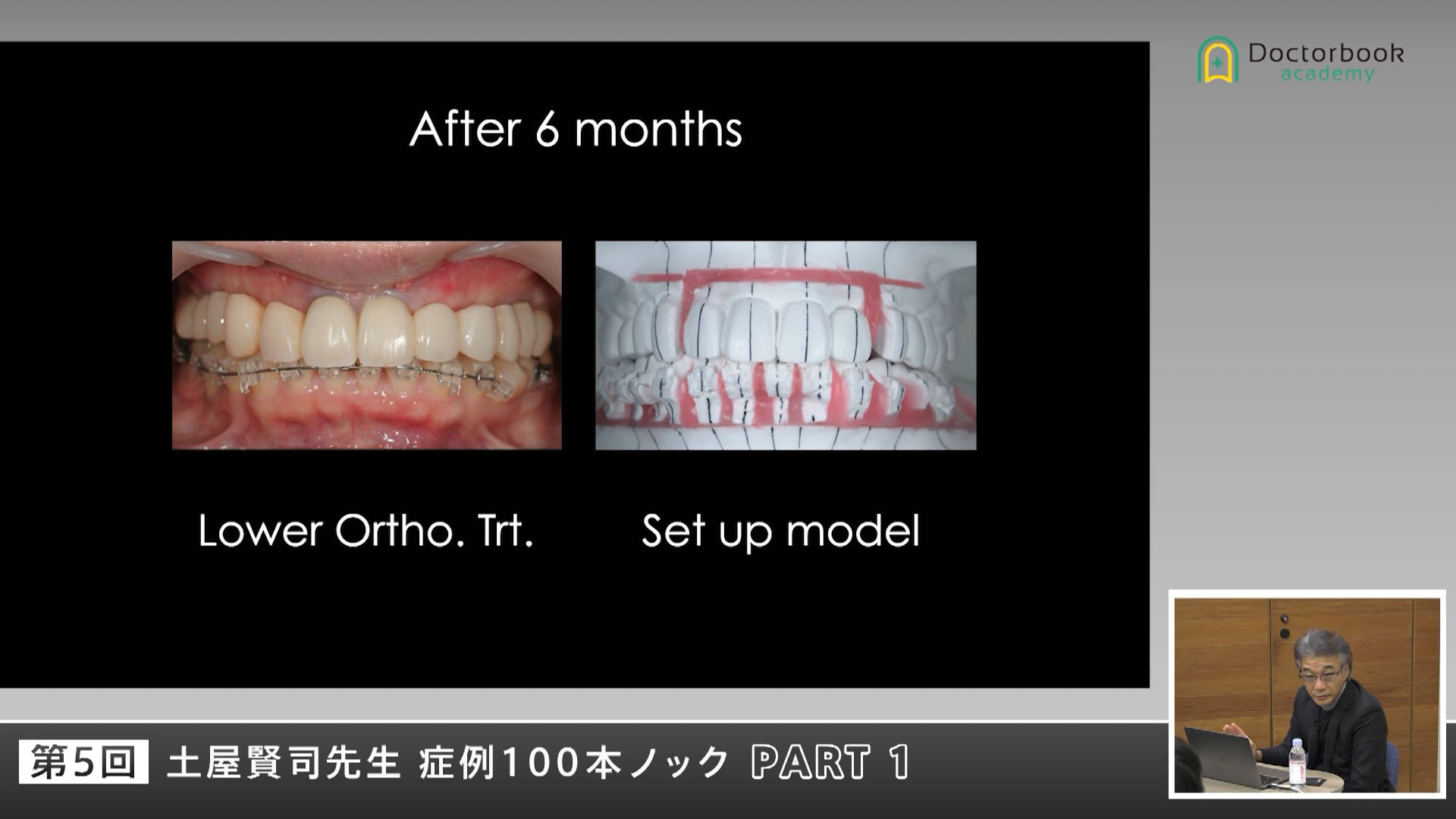 矯正とインプラントを組み合わせた包括的治療設計 #1