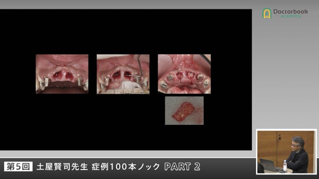 開口・再治療・抜歯・リカバリーから学ぶ臨床判断 #2