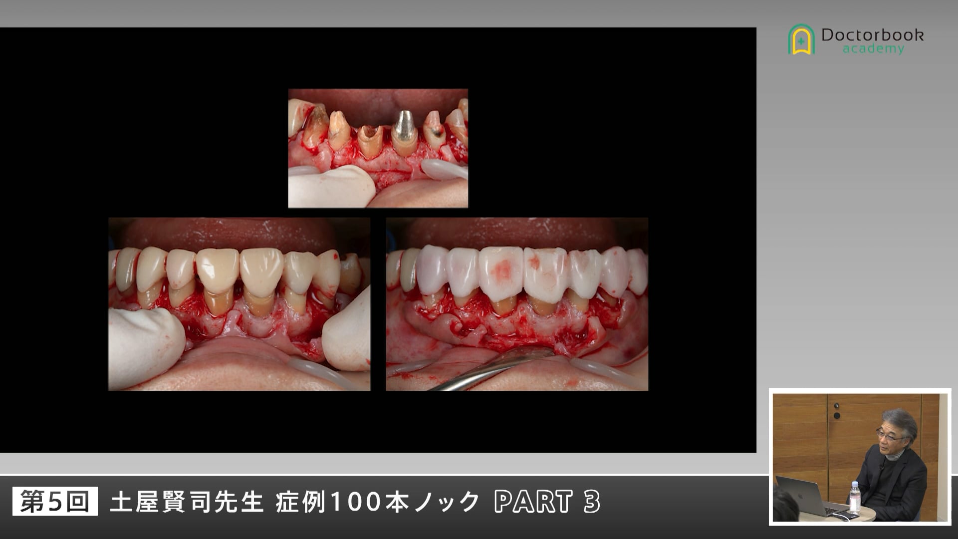 インプラントを含む複雑症例ー予後不良・再治療・機能障害 #3