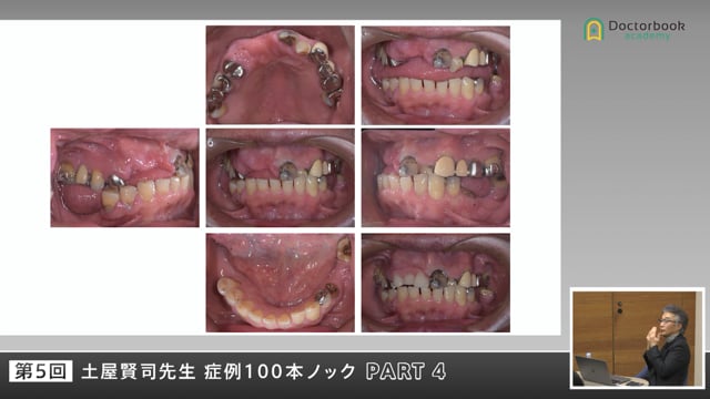 咬合崩壊・摂食障害・重度ペリオから学ぶ臨床の原点 #4