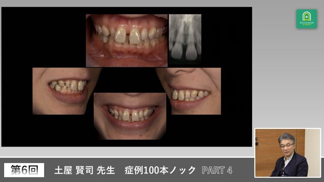 正中離開とブラックトライアングルを読み解く臨床 #4