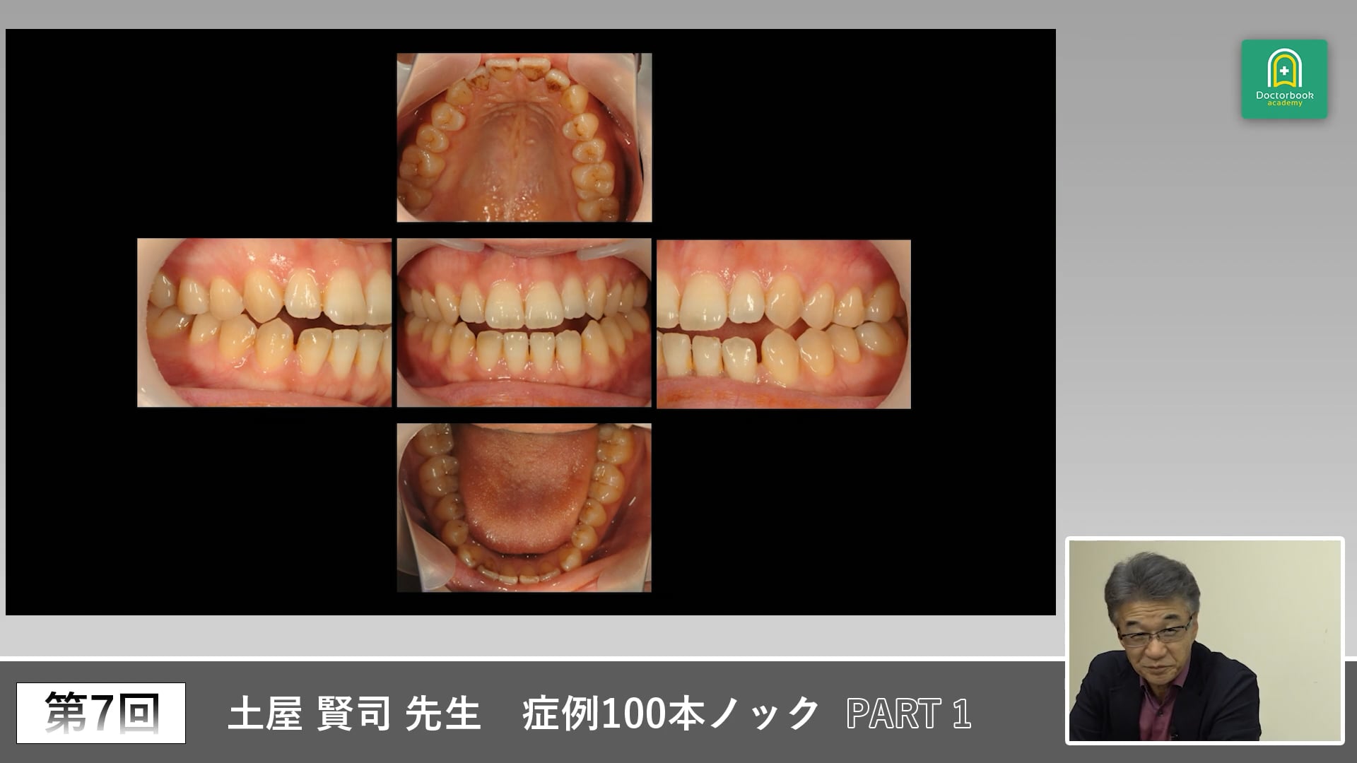 初診パノラマで考える顎関節症と前歯突出の症例 #1