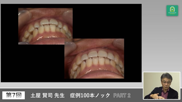 正中のズレと矯正後補綴から学ぶ審美設計 #2