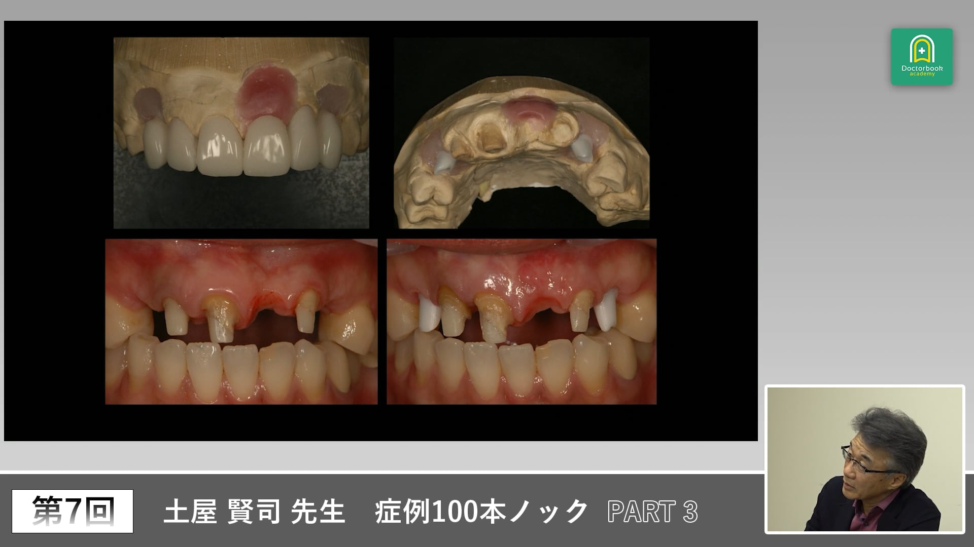 前歯部審美の複雑症例を読み解く実践講義 #3