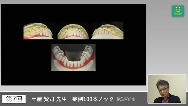歯周外科後の全顎審美補綴と咬合再構築の実際 #4