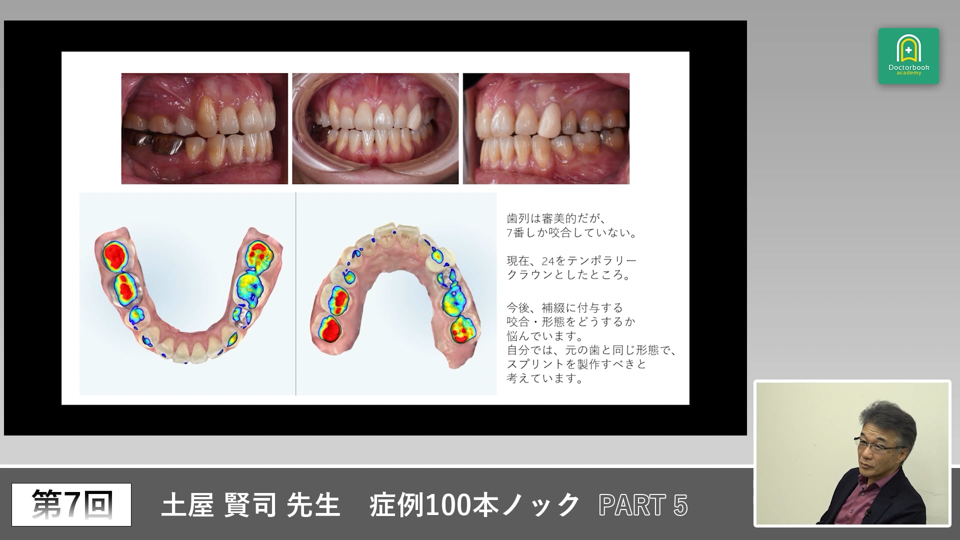 矯正後の開咬症例と咬合再構成トラブルへの対応 #5