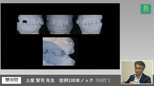 抜歯後の欠損補綴をどう考えるかを学ぶパノラマ症例 #1