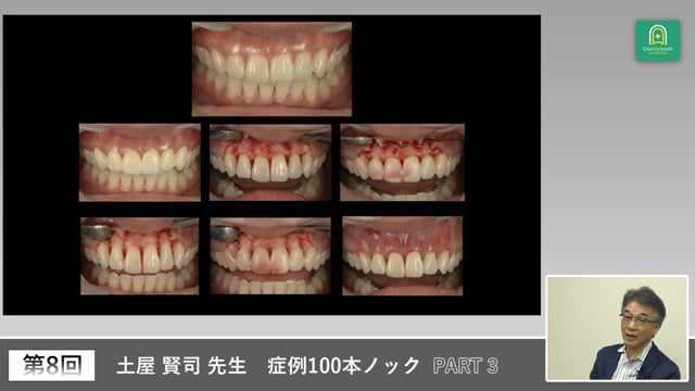 ガミースマイル症例の診断からサージカルガイド作製まで #3