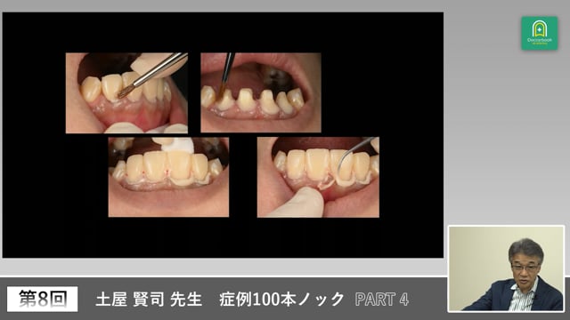 プロビジョナル調整から最終形成までの歯周コントロール #4