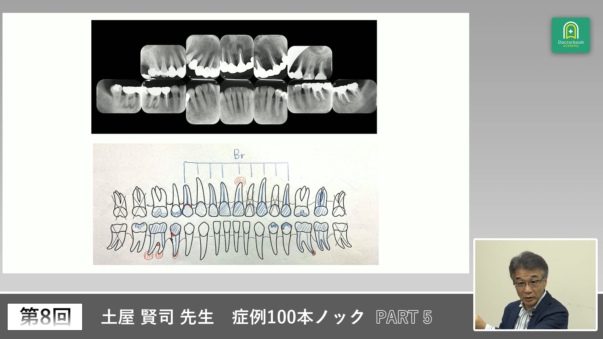 外科処置を拒否する患者対応と埋伏犬歯症例 #5