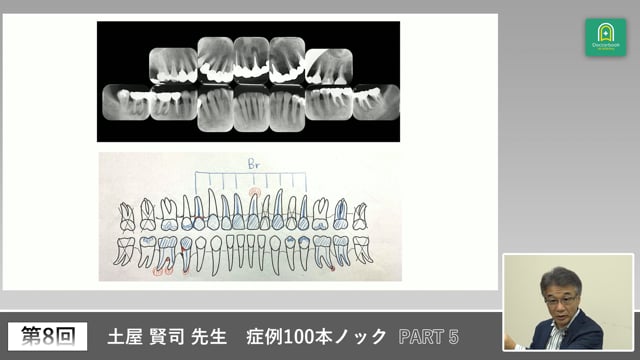 外科処置を拒否する患者対応と埋伏犬歯症例 #5