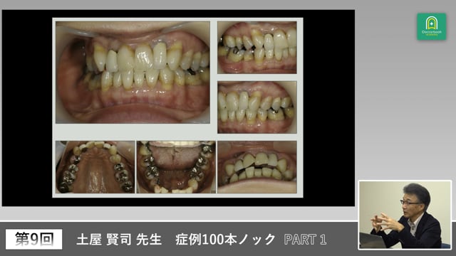 智歯の痛みと臼歯咬耗症例から学ぶ初診パノラマ診断 #1
