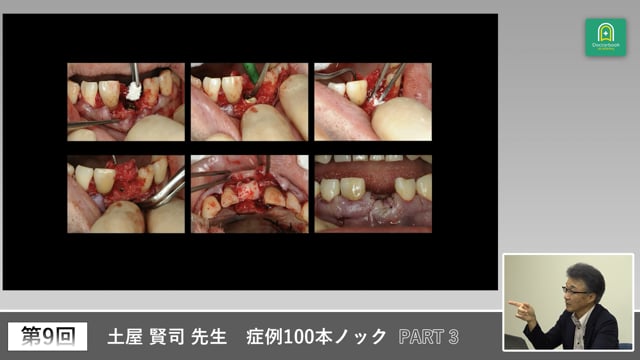 硬組織・軟組織・位置決めから学ぶ審美インプラントの原理 #3
