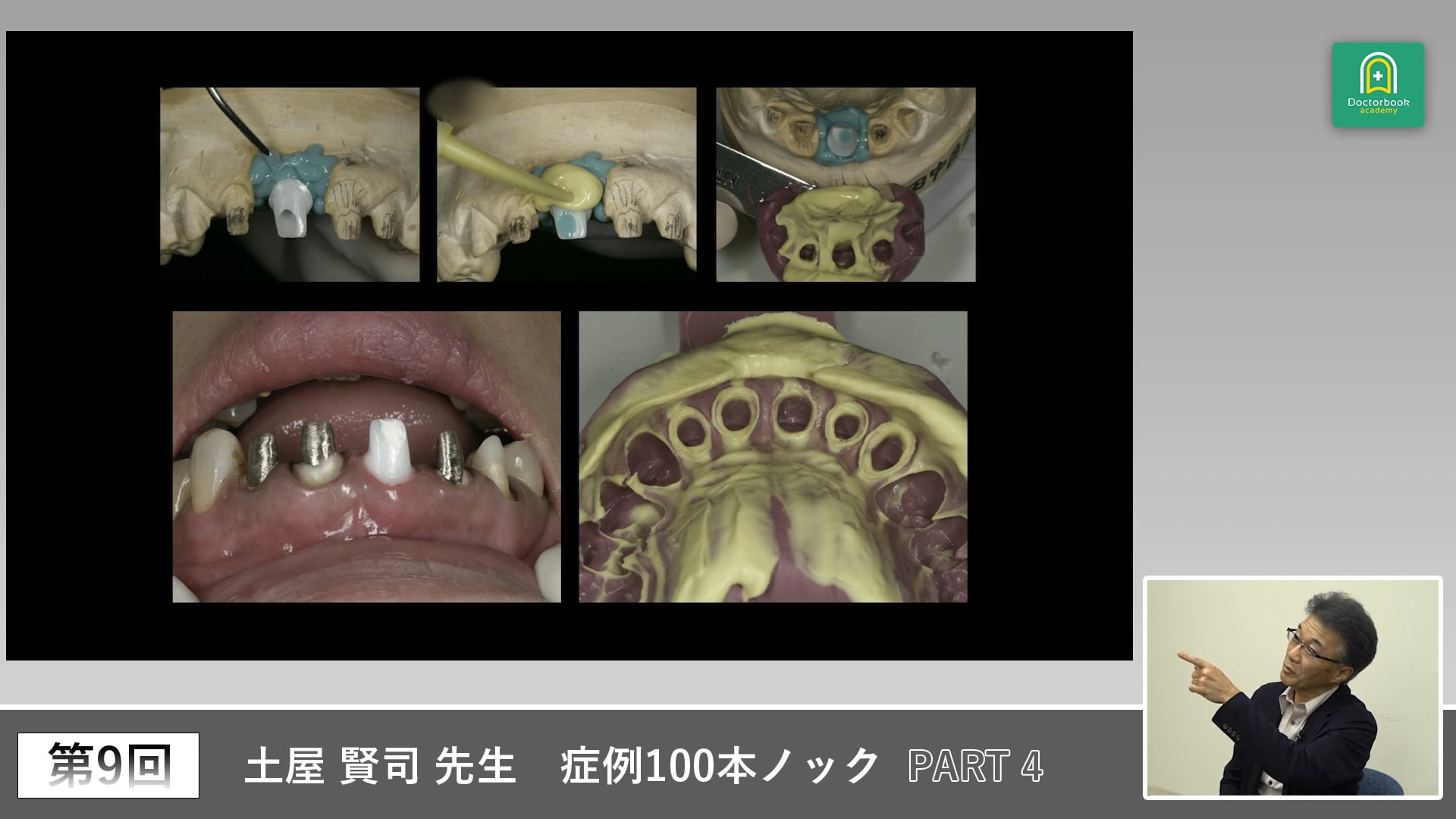 歯根破折に対するソケットプリザベーションと審美インプラントの実際 #4