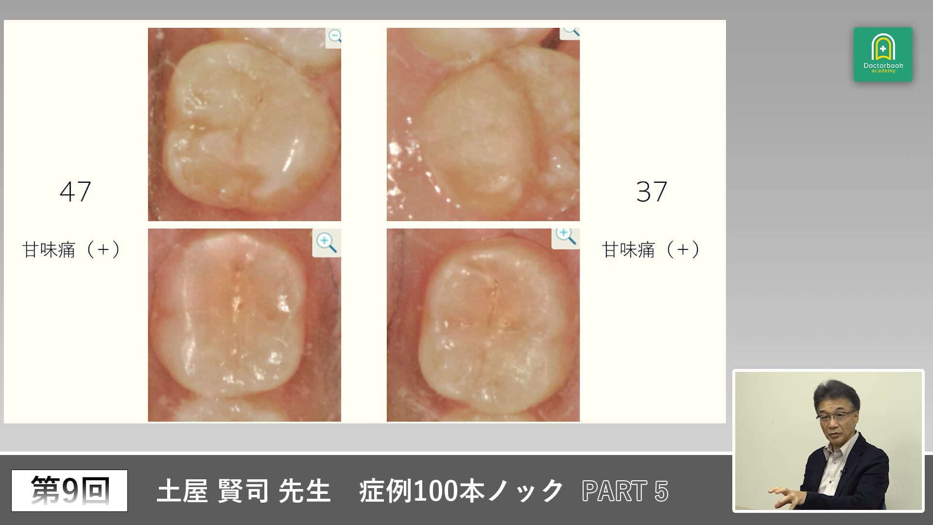 インプラント治療の実践Q&A　ソケットプリザベーションと失敗防止の考え方 #5