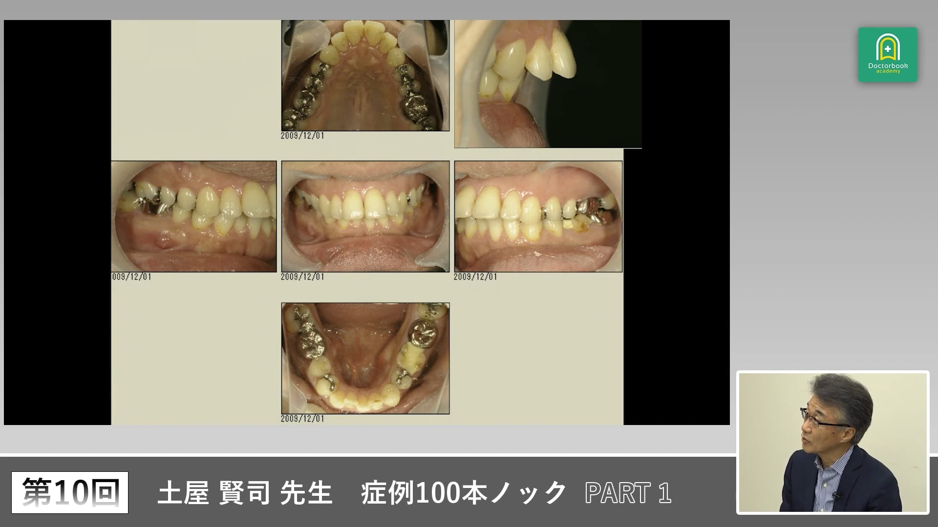セカンドオピニオン症例と咬合安定から学ぶ臨床判断 #1
