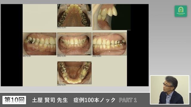 セカンドオピニオン症例と咬合安定から学ぶ臨床判断 #1