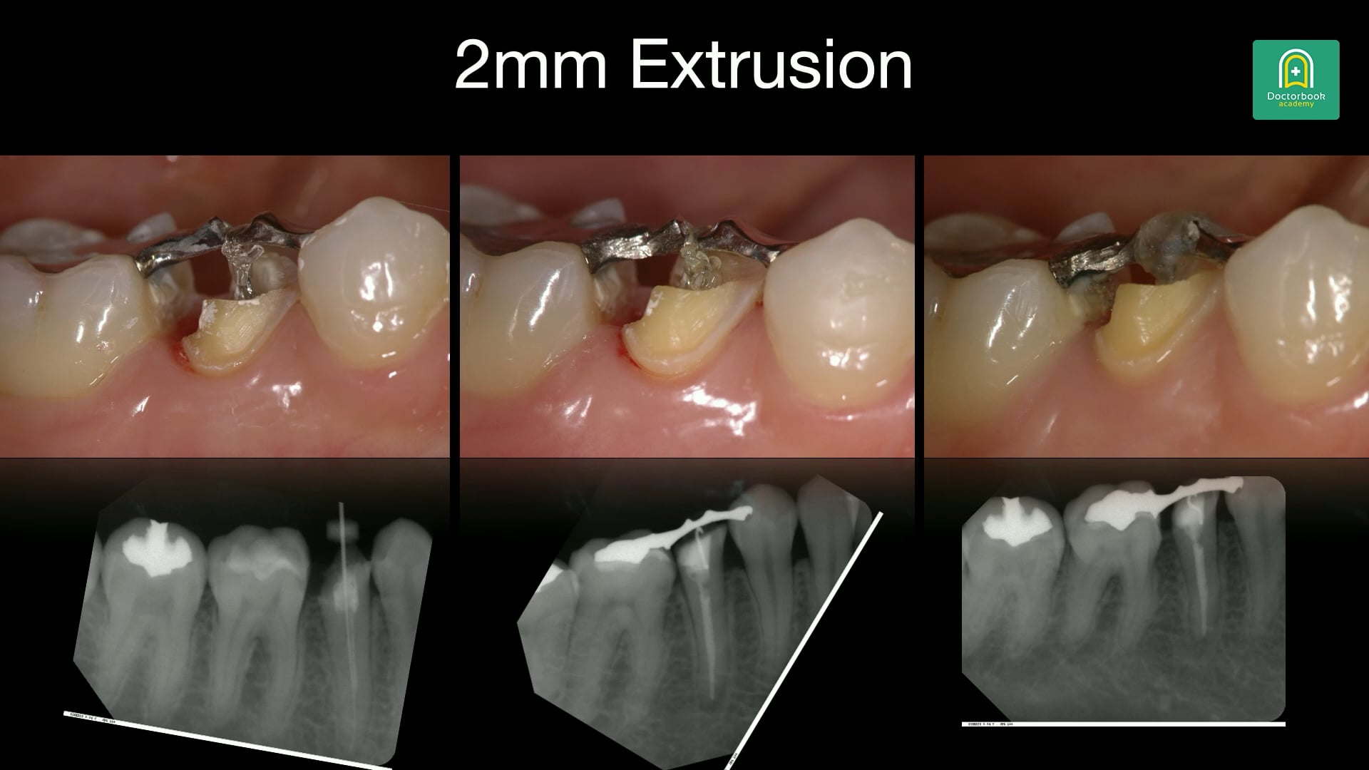 フルマウスリコンストラクション症例から学ぶ成長と挑戦 #2