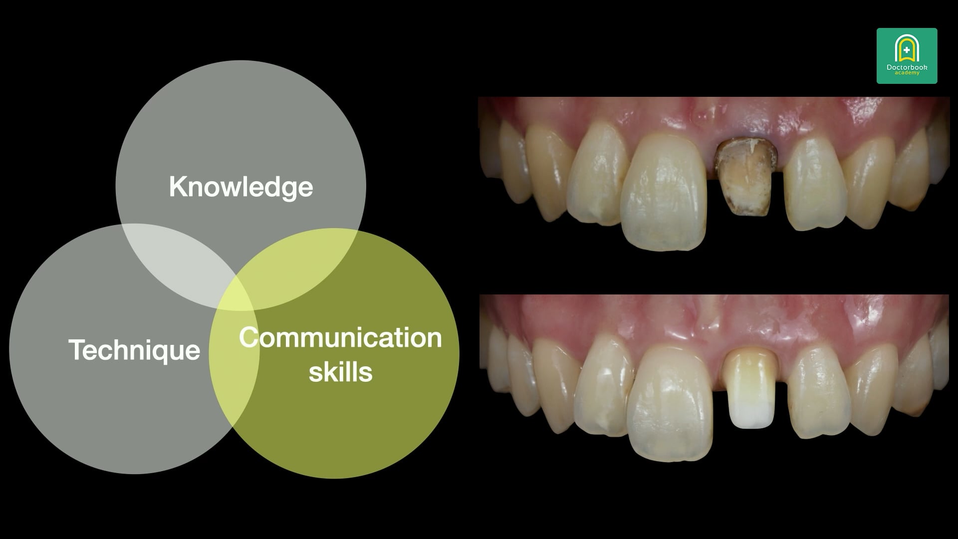 咬合再構成の症例プレゼンとコンサルテーションの実践 #3