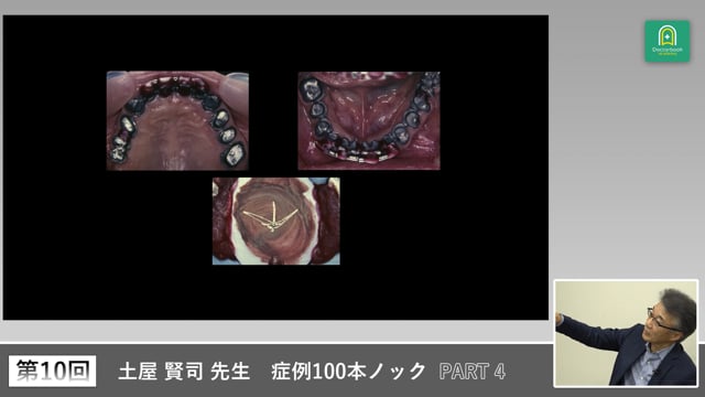 重度歯周病症例の30年経過に学ぶ長期安定の秘訣 #4