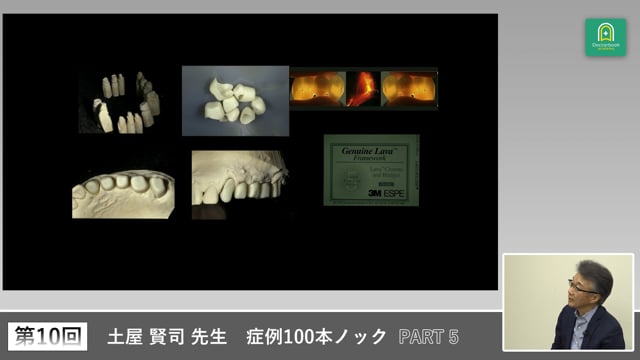重度ブラキサー症例の30年経過に学ぶ咬合安定と補綴設計 #5