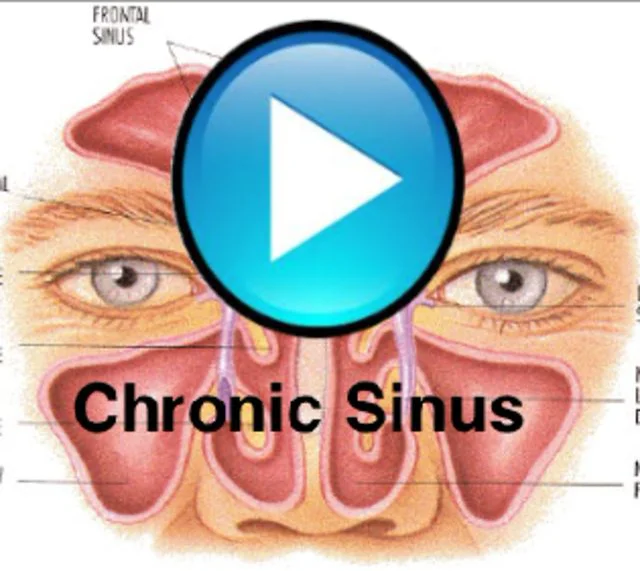 Chronic Sinusitis on Vimeo