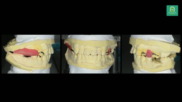 38歳男性の咬合崩壊症例　意識改革を起点にした治療計画 #3