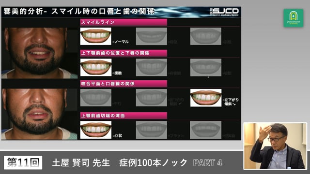 左側欠損と咬合平面下がりを再設計するインプラント相談症例 #4