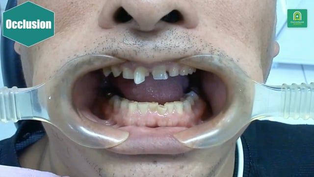 フルマウス咬合再構成に挑む53歳男性症例 #1