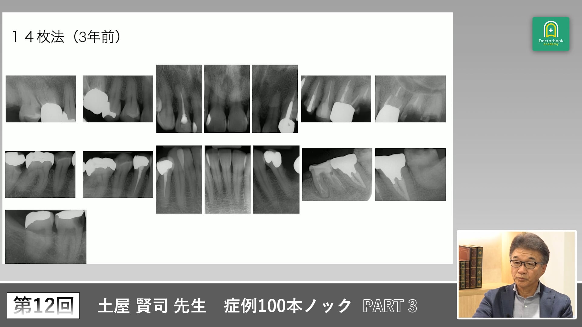 左側で噛めない50歳女性　犬歯誘導喪失とTEC脱離の対処 #3