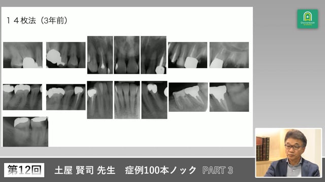 左側で噛めない50歳女性　犬歯誘導喪失とTEC脱離の対処 #3