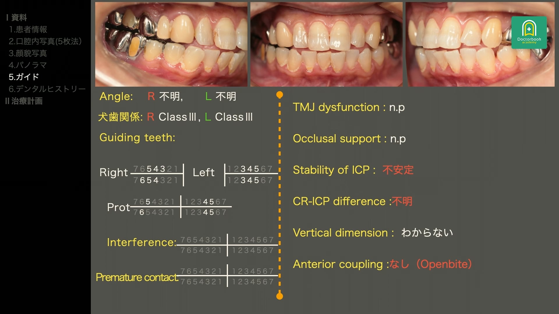 開咬を伴う臼歯部咬合崩壊と力のコントロールを考える症例 #4