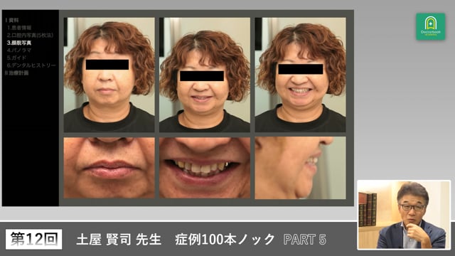 開咬症例をさらに深掘りする舌癖・気道・咬合管理の実際 #5