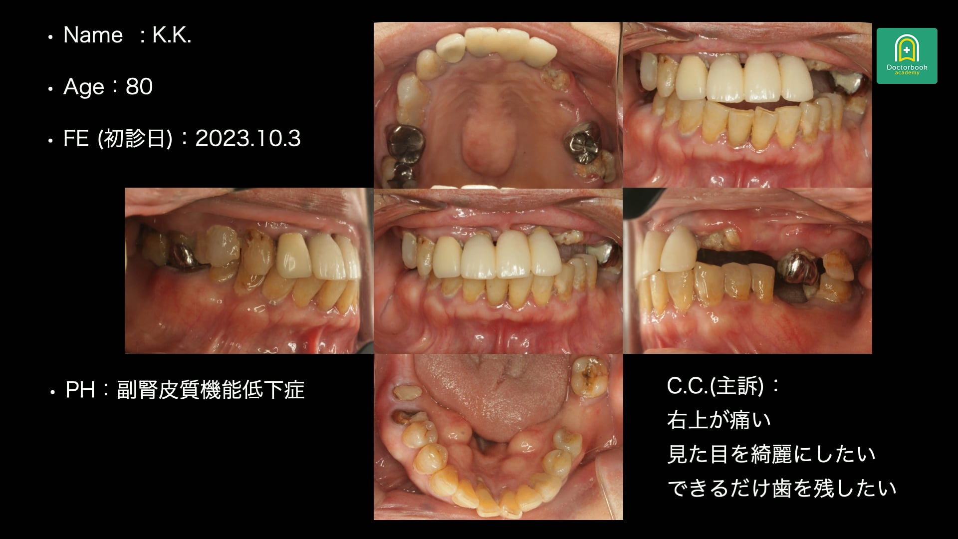 全身疾患を背景に咬合崩壊した80歳女性のフルマウス治療戦略 #1