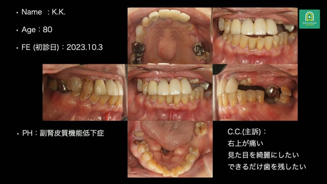 全身疾患を背景に咬合崩壊した80歳女性のフルマウス治療戦略 #1