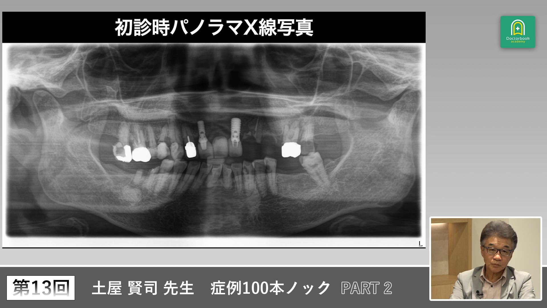 すれ違い咬合に対する欠損補綴とバーティカルストップ再構築の実際 #2