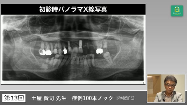 すれ違い咬合に対する欠損補綴とバーティカルストップ再構築の実際 #2
