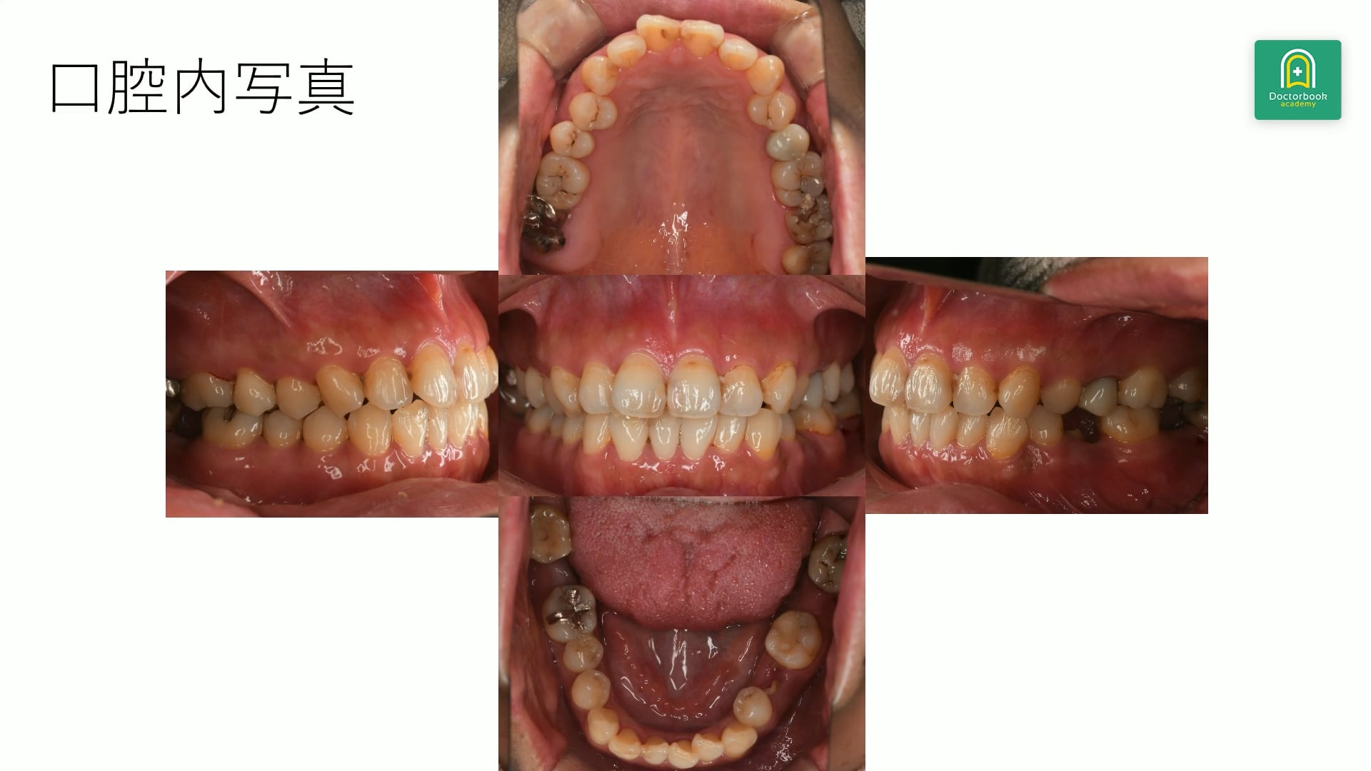 少数歯欠損と近心傾斜歯を前提に組み立てる欠損補綴と矯正判断 #3
