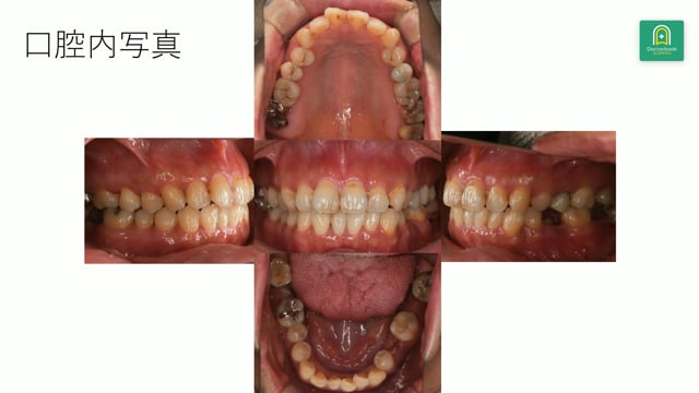 少数歯欠損と近心傾斜歯を前提に組み立てる欠損補綴と矯正判断 #3